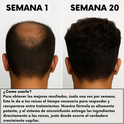 RegenCapilar™ - Protocolo clínico recuperación capilar para uso en casa - RegenCapilar