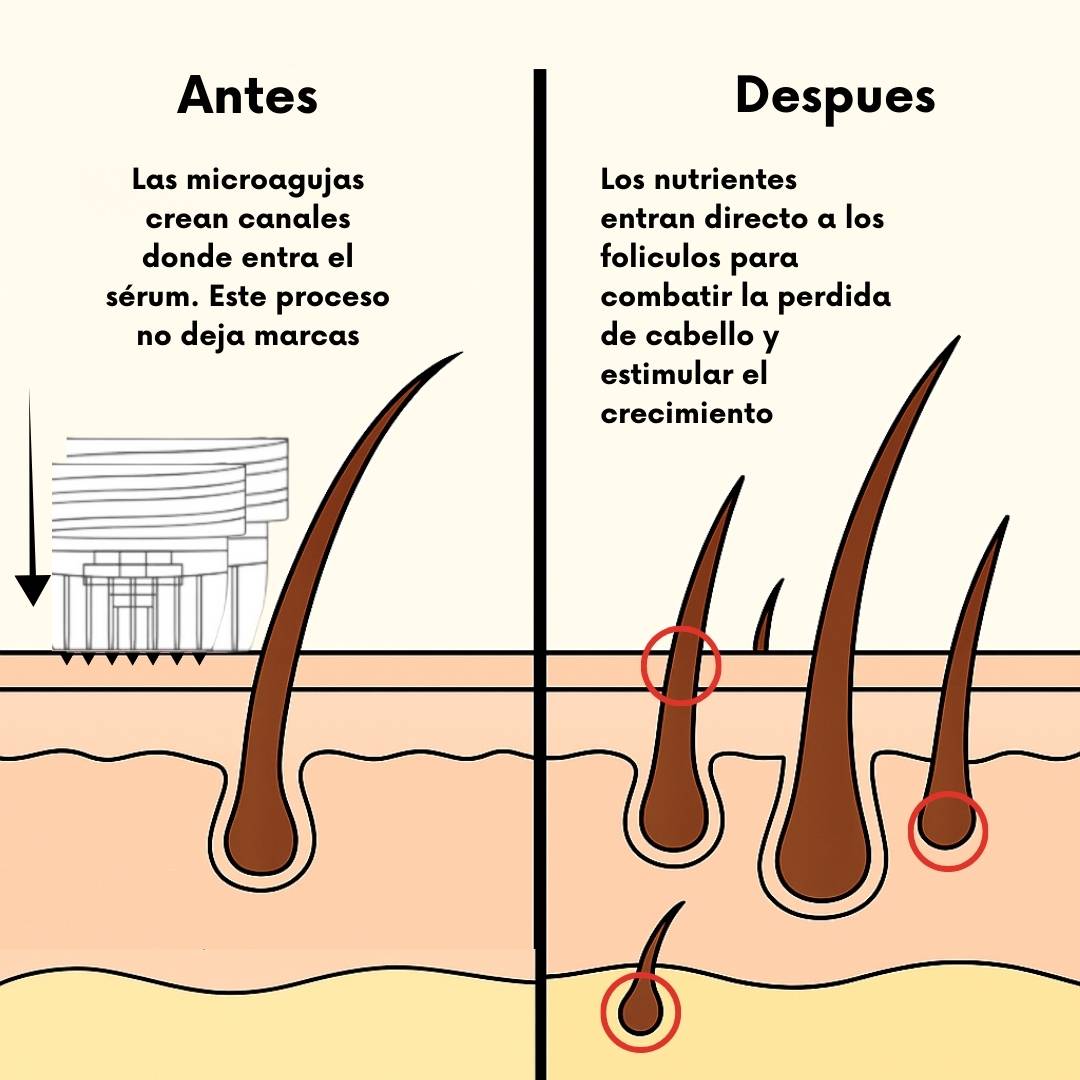RegenCapilar™ - Protocolo clínico recuperación capilar para uso en casa - RegenCapilar